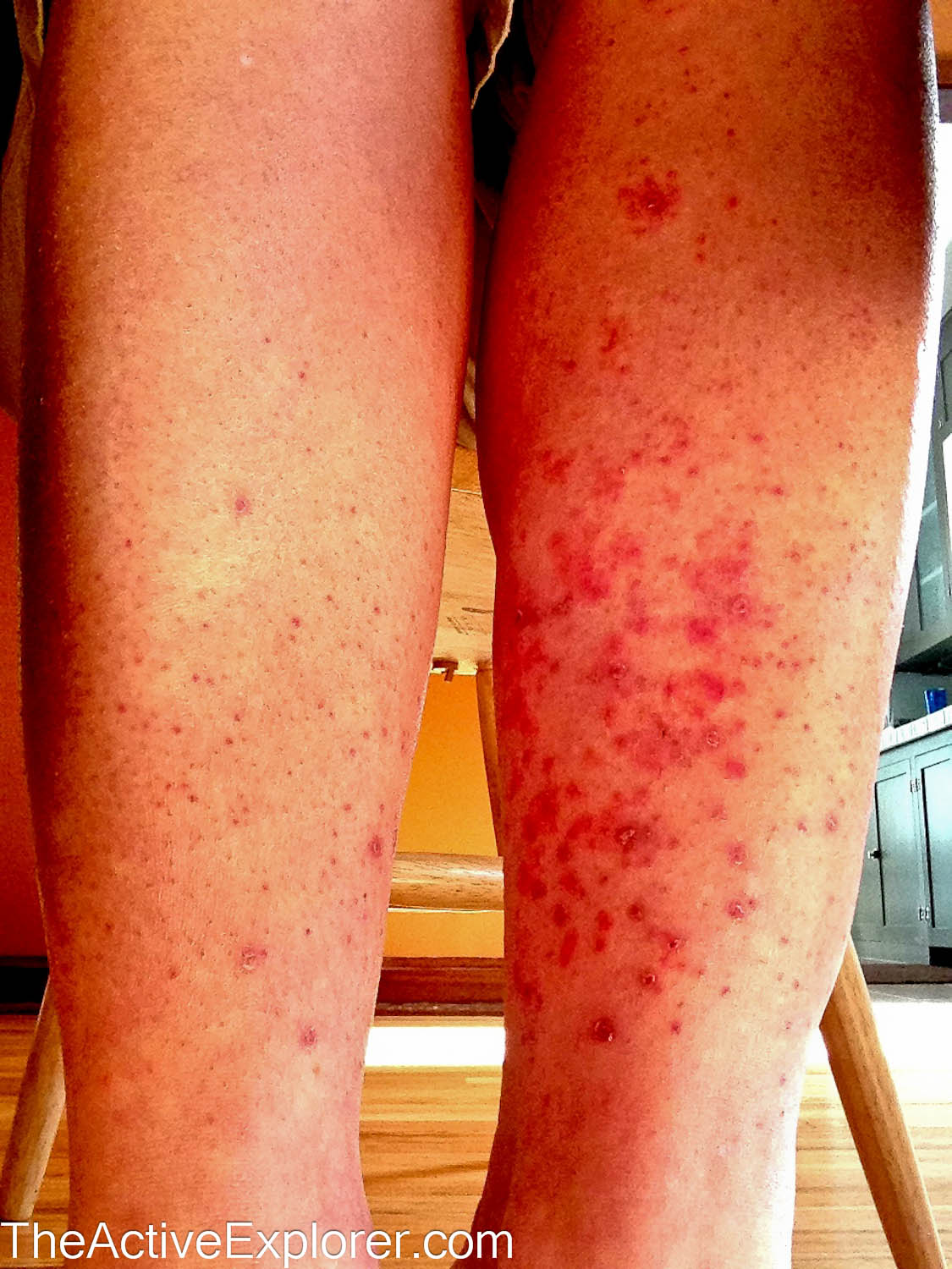 My legs today, 18 days following the tick bites